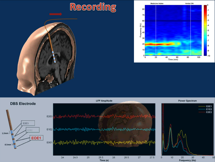 Parkinson’s Surgery Research Wins NSF Grant