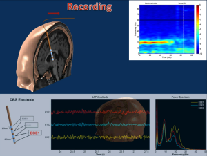 Nuri Ince with the University of Houston Cullen College of Engineering will use data recorded by a deep brain probe to target the subthalamic nucleus, a section of the brain that misfires in Parkinson’s patients.