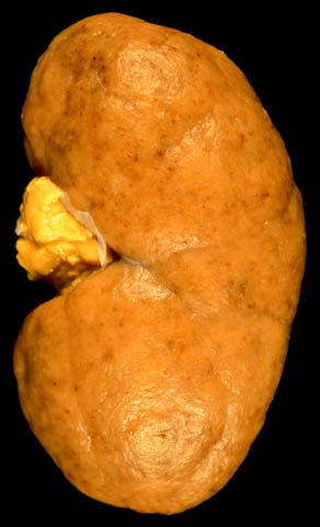 Kidney from a lupus nephritis patient