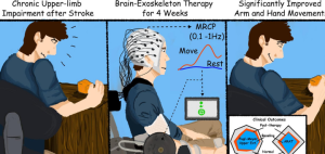 A clinical trial found that stroke survivors gained clinically significant arm movement and control by using an external robotic device powered by the patients’ own brains.