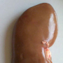 A healthy human kidney (above) and a kidney from a lupus nephritis patient (below), which shows the disease's classic "flea bitten" look.