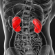 Researchers Propose New Treatment to Prevent Kidney Stones