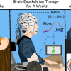 A clinical trial found that stroke survivors gained clinically significant arm movement and control by using an external robotic device powered by the patients’ own brains.